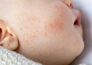 bebeklerde egzama neden olur