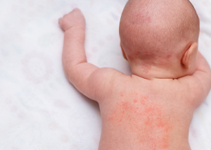 bebeklerde egzama nasıl geçer