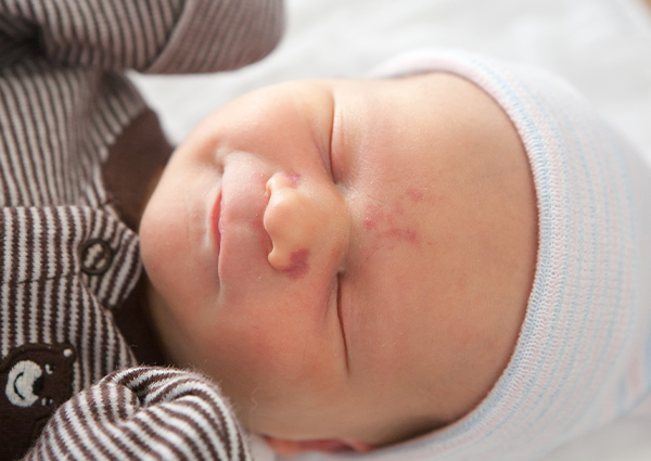 Doğum Lekesi Neden Olur