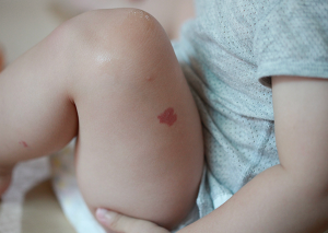 doğum lekesi nasıl geçer