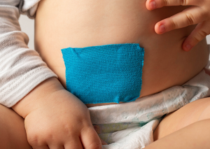 bebeklerde göbek fıtığı fotoğrafları