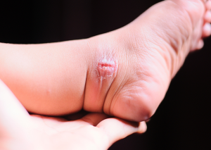 bebeklerde uyuz tedavisi