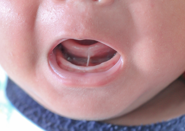 bebeklerde dil bağı