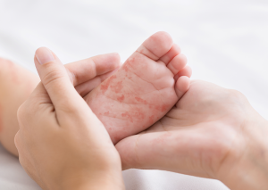 bebeklerde kızamık