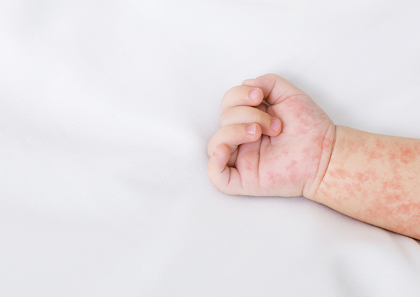 bebeklerde kızamık