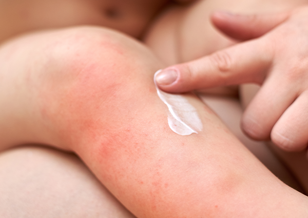 bebekler ve güneş alerjisi